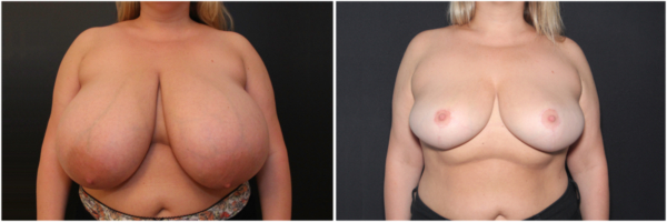 breast-reduction-aa-before-and-after