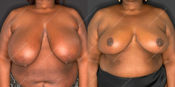 breast-reduction-before-and-after-BR.1907.AP .7month