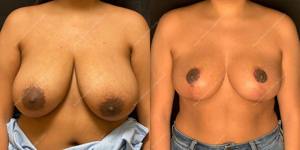 breast-reduction-before-and-after-BR.2870.AP .3month.lipo 