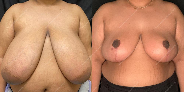 breast-reduction-before-and-after-BR.2934.AP .3month.lipo 