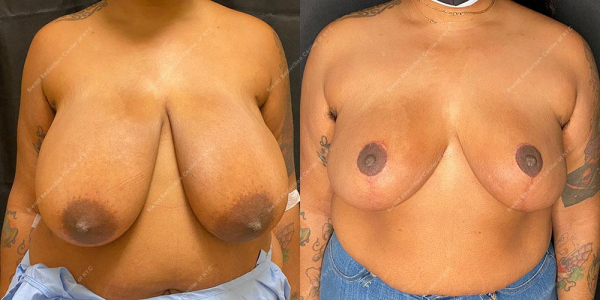 breast-reduction-before-and-after-BR.2936.AP .4month.lipo 