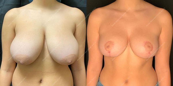 breast-reduction-before-and-after-BR.3017.AP .3month.lipo 
