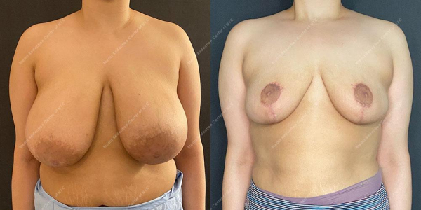 breast-reduction-before-and-after-BR.3145.AP .5month.lipo 