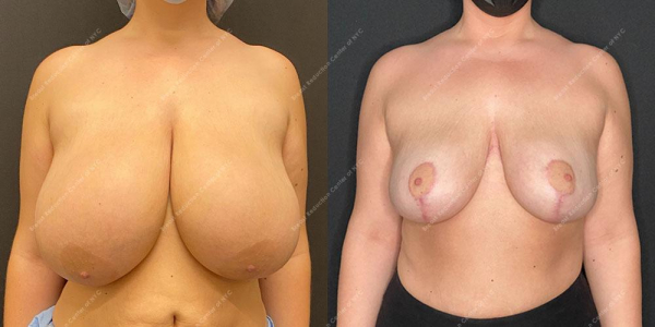 breast-reduction-before-and-after-BR.3163.AP .3month.lipo 