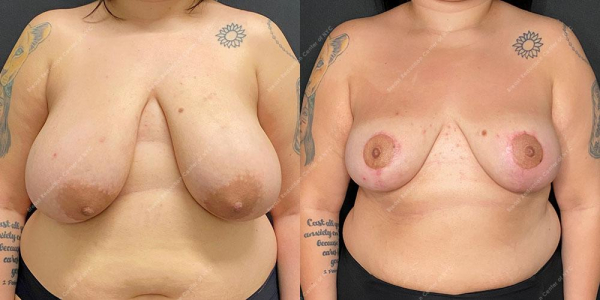 breast-reduction-before-and-after-BR.3266.AP .3month.lipo 