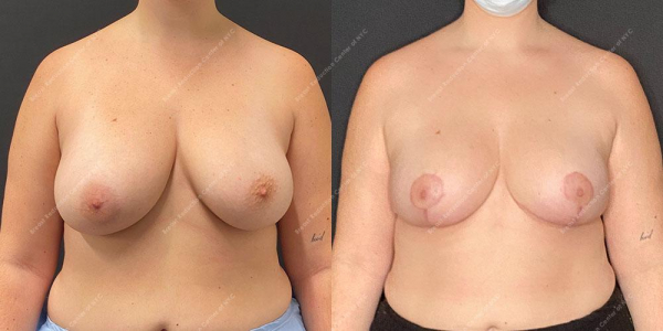 breast-reduction-before-and-after-BR.3613.AP .5month.lipo 
