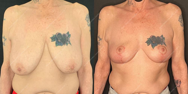 breast-reduction-before-and-after-BR.EK .4220.AP .3month.lipo 