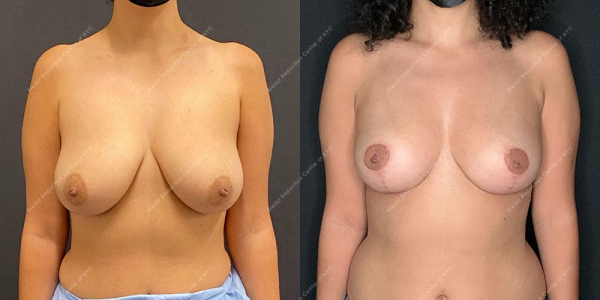breast-reduction-before-and-after-BR.FH .3341.AP .5month.lipo 