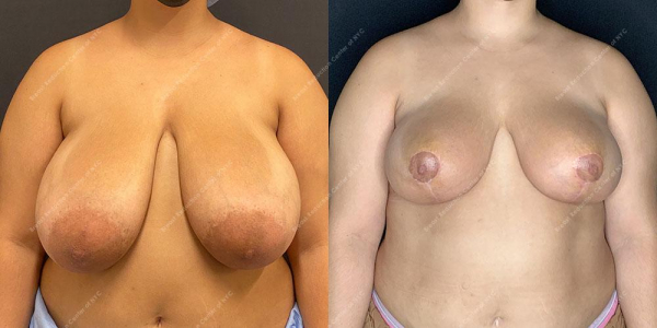 breast-reduction-before-and-after-BR.FH .3960.AP .2month.lipo 
