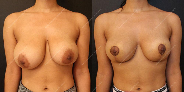 breast-reduction-before-and-after-Mastopexy.1022.AP .2week