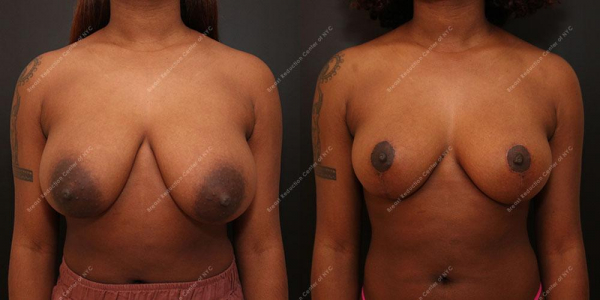 breast-reduction-before-and-after-Mastopexy.1463.AP .1month