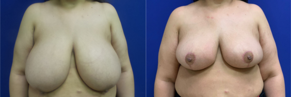 breast-reduction-cd-before-and-after