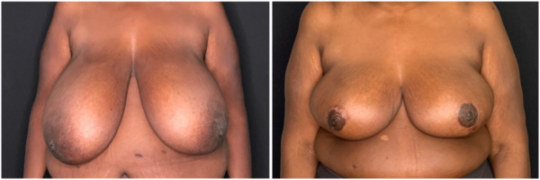 breast-reduction-db-before-and-after