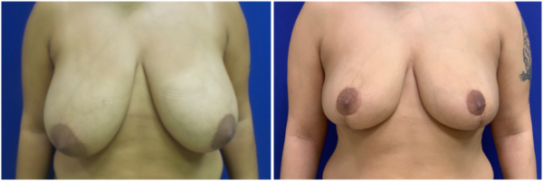 breast-reduction-gr-before-and-after-1-1