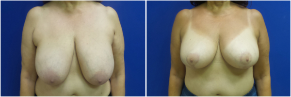 breast-reduction-mv-before-and-after
