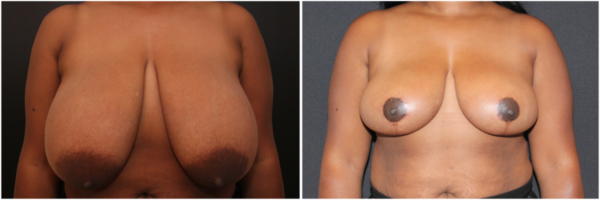 breast-reduction-my-before-and-after