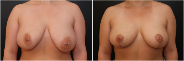 breast-reduction-ob-before-and-after