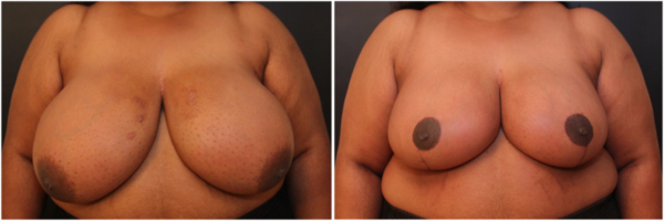 breast-reduction-on-before-and-after