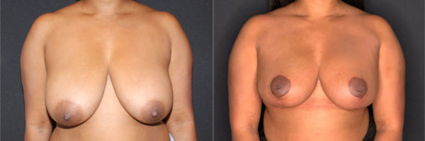 breast-reduction-sh-before-and-after