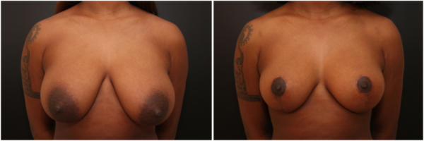 breast-reduction-sw-before-and-after
