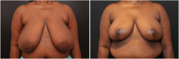 breast-reduction-ym-before-and-after